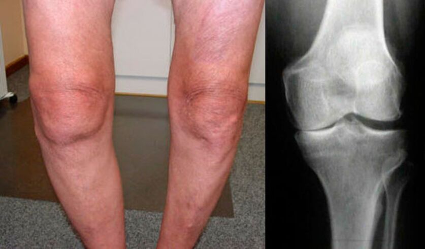 artrosi dell'articolazione del ginocchio