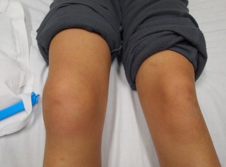deformità dell'articolazione del ginocchio con artrosi